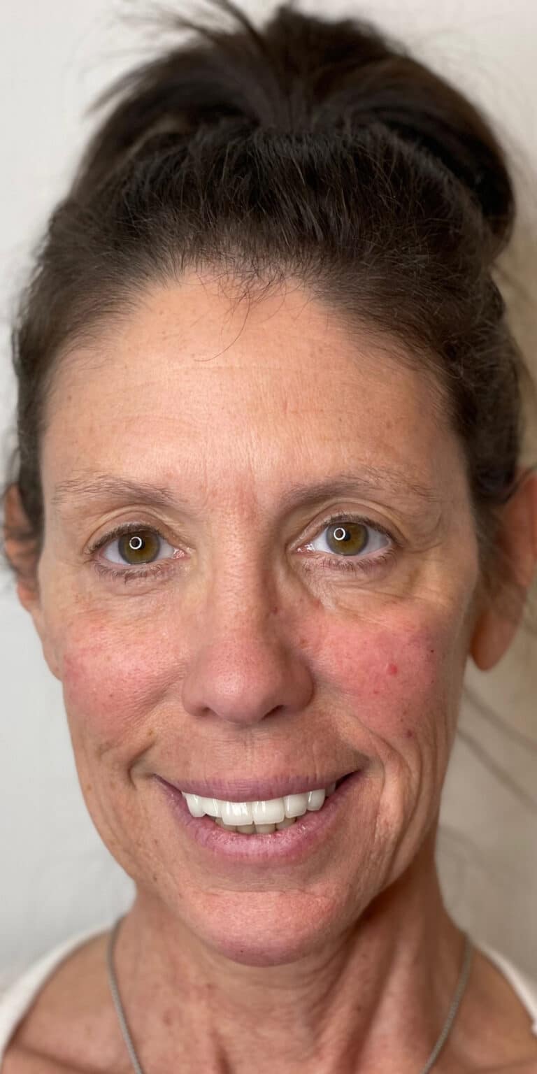 After Image: Dermal Filler - front