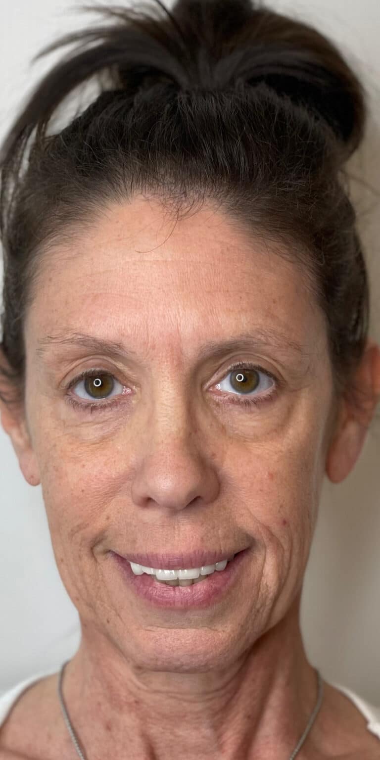 Before Image: Dermal Filler - front