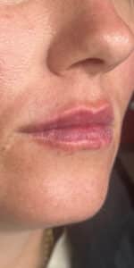 After Image: Lip Filler