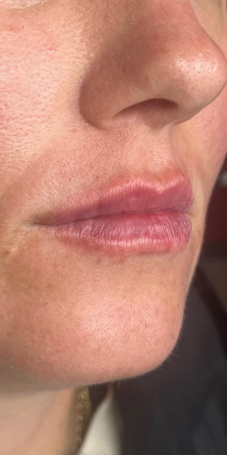 After Image: Lip Filler - right-front-oblique