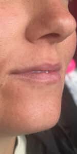 Before Image: Lip Filler