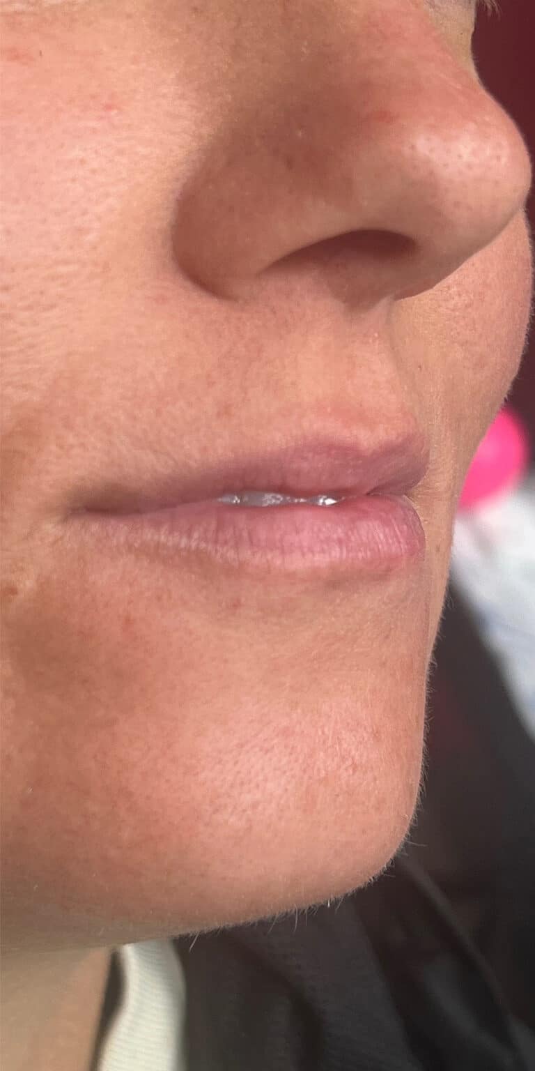 Before Image: Lip Filler - right-front-oblique