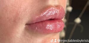 After Image: Lip Filler