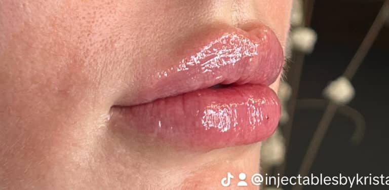 After Image: Lip Filler - right-front-oblique