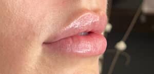 Before Image: Lip Filler
