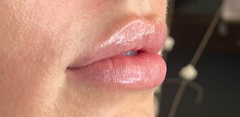 Before Image: Lip Filler - right-front-oblique