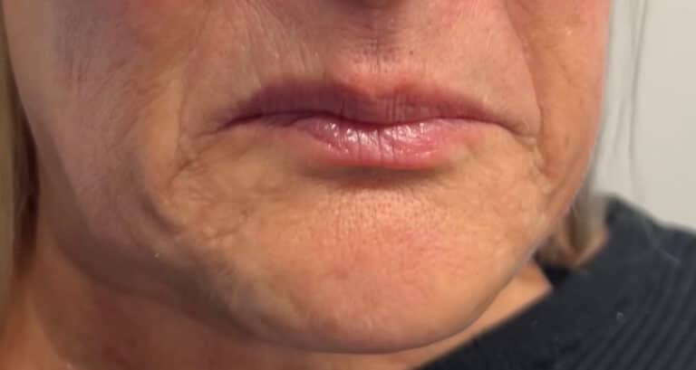 After Image: Neuromodulator - right-front-oblique