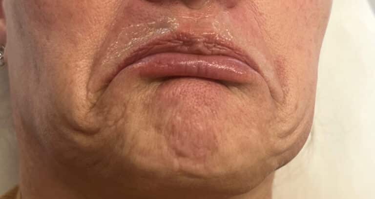 Before Image: Neuromodulator - right-front-oblique