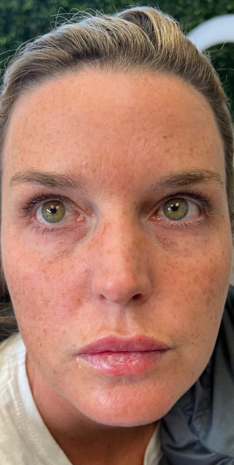 After Image: Neurotoxin and Filler - front