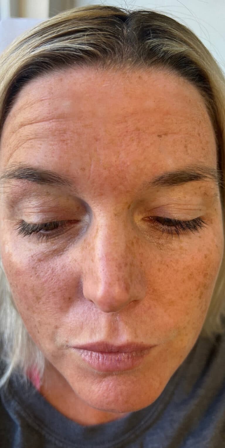 Before Image: Neurotoxin and Filler - front