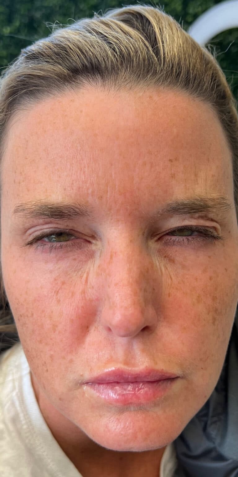 After Image: Neurotoxin and Filler - front