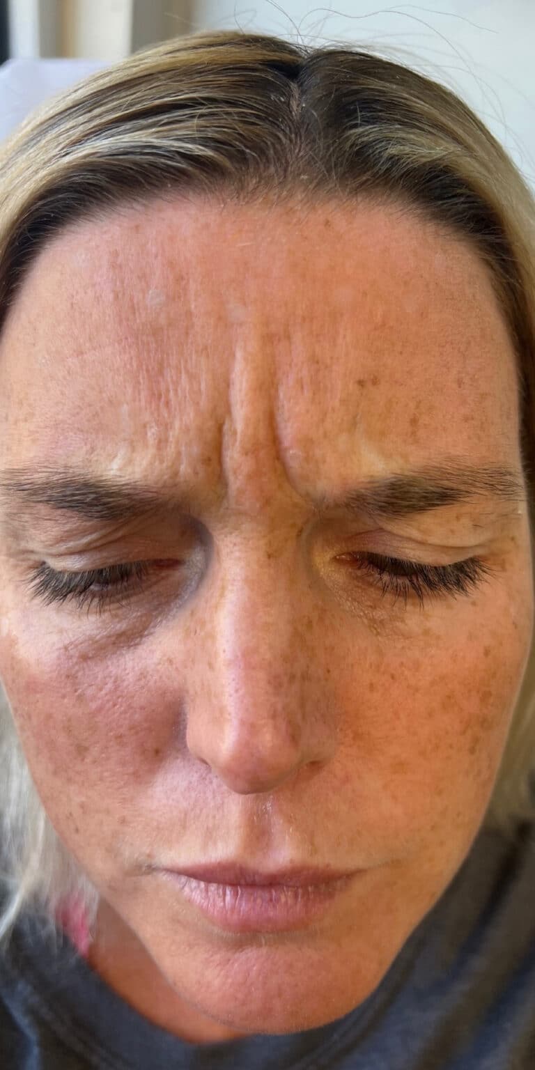 Before Image: Neurotoxin and Filler - front